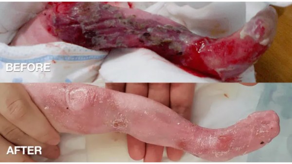 EB Skin Disease Bandage & Pain Medicine Fund For Children: Campaign Expanded EB Skin Disease Bandage & Pain Medicine Fund For Children: Campaign Expanded